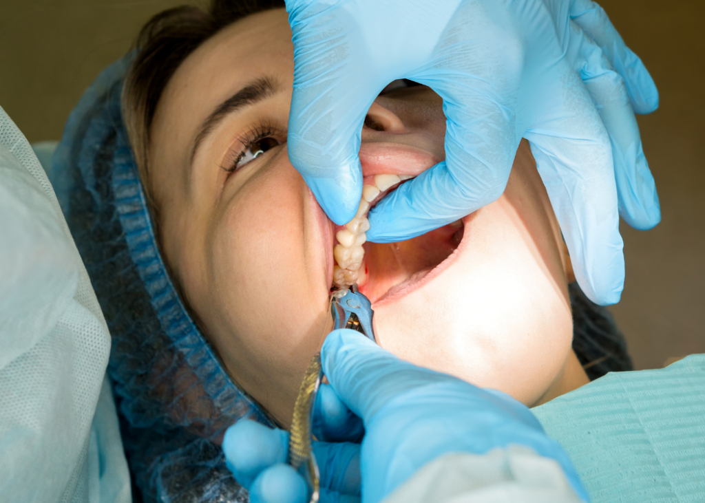 Tooth Extraction: The Complete Guide to Treatment, Recovery and Aftercare
