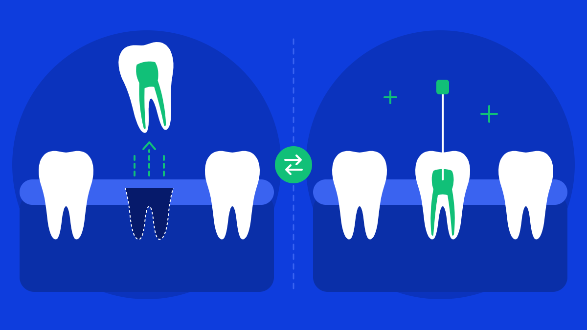 Tooth Extraction vs Root Canal